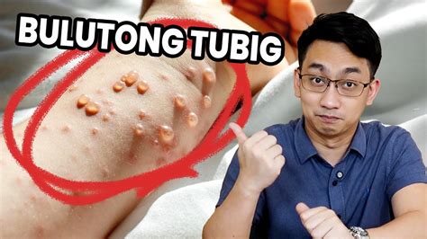 Bulutong Tubig: Ano Ito, Sintomas, at Maaring Gawin .